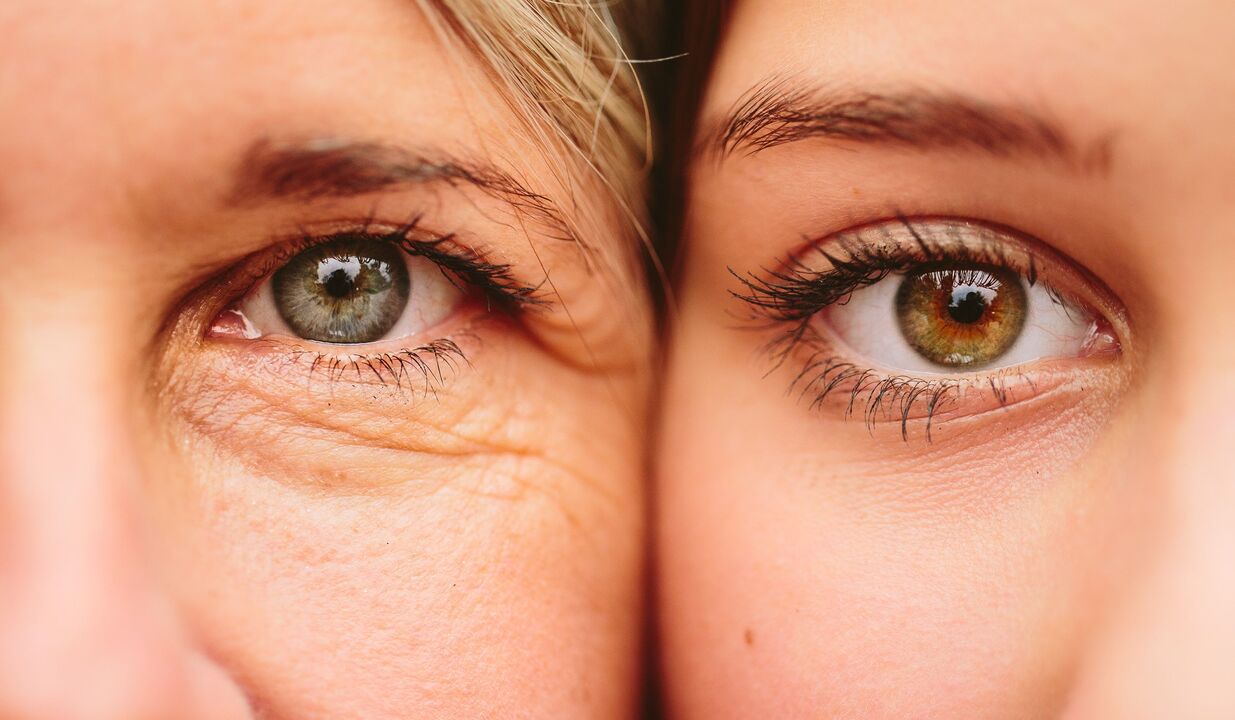 vananemise märgid silmade ümber