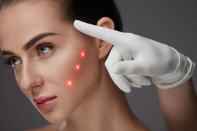 Naha laseri noorendamine